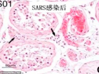 El coronavirus de Wuhan podría causar infertilidad masculina según estudios chinos