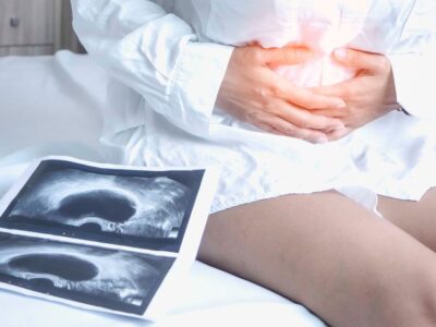 Nuevos avances en el tratamiento de los ovarios poliquísticos, según un artículo publicado por la clínica MARGen